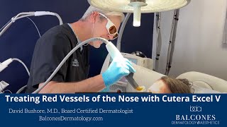 Treating Redness of the Nose with Cutera Excel V Plus Laser  David Bushore MD  Ph 5124594869 [upl. by Sion774]