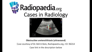 Obstructive ureterolithiasis ultrasound Radiopaediaorg Cases in Radiology [upl. by Anna-Diane150]