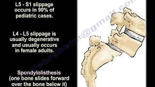 SpondylolysisSpondylolisthesisSpondylitisampSpondylosisEverythingYou Need To KnowDrNabil Ebraheim [upl. by Dirgis]