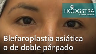 Blefaroplastia asiática o de doble párpado 19009 [upl. by Auohs]