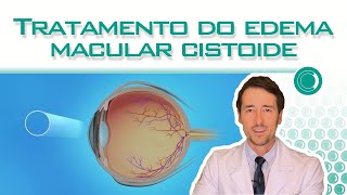 Tratamento do Edema Macular Cistóide [upl. by Lipfert663]