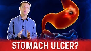 How To Get Rid Of Stomach Ulcer – DrBerg On Peptic Ulcer Treatment [upl. by Yrevi190]