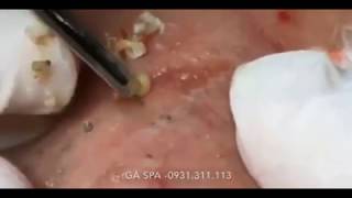 BIGGER SIDE BY SIDE BLACKHEADS PULLED OUT [upl. by Portia]