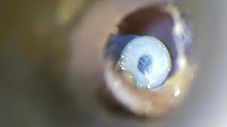 Gruesome Footages Shows Removal Of Ear Grommets [upl. by Nelra]