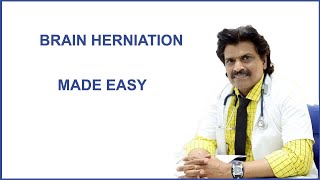 BRAIN HERNIATION MADE EASY [upl. by Ariaet665]