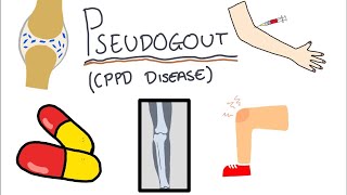 Pseudogout Calcium Pyrophosphate Disease  Simple and easy to understand [upl. by Nosreve520]