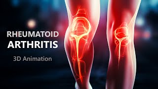 ආතරයිටීස් රෝගය 😨 What is rheumatoid arthritis  symptoms  causes in sinhala [upl. by Abbate236]