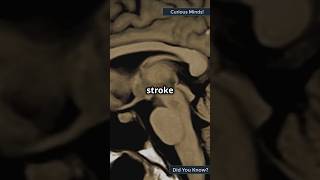 Recognizing the Warning Signs of a Stroke A LifeSaving Guide [upl. by Earehc]