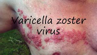 How to Pronounce Varicella zoster virus [upl. by Michel]