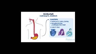 Achalasia A Disorder of the Esophagus health [upl. by Namie]