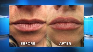 New Lip Filler Results [upl. by Aniroc24]