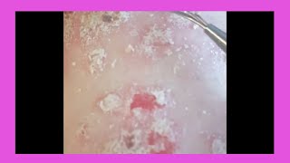 Plaque Psoriasis Removal  How to remove psoriasis [upl. by Quarta]