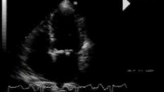 calcific aortic stenosismitral annular calcification and flail mitral valve 22 [upl. by Allsun]