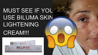 DO NOT use BILUMA without watching this video [upl. by Yun94]