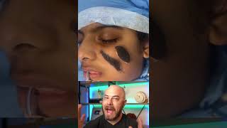 Doctor explains huge hairy nevus removal dermreacts doctorreacts hairynevus [upl. by Opaline]