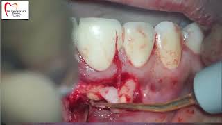 Microsurgery with conservative flap design [upl. by Loseff]