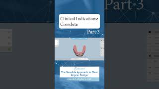 Clinical Indications Crossbite Part 3 [upl. by Drucy]