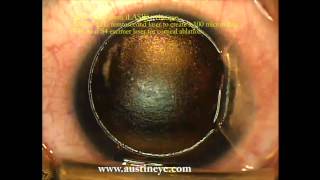 LASIK surgery explained stepbystep by Shannon Wong MD 122111 [upl. by Eldrida205]