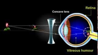 what is myopia Short Sightedness [upl. by Loomis]