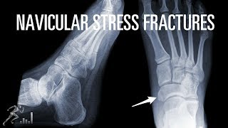 How can you quickly recover from a navicular stress fracture [upl. by Eimirej]