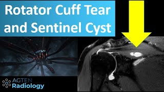 Rotator Cuff Tears and Sentinel Cysts on MRI [upl. by Mittel]