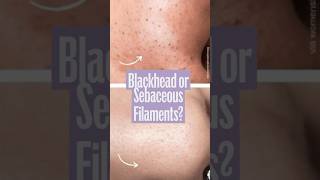 Blackheads or Sebaceous Filaments skincare blackheads sebaceousfilaments [upl. by Harrow834]