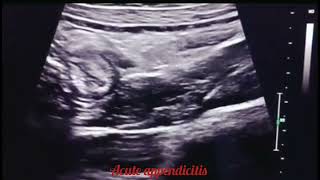 acute appendicitis sonography ultrasoundscans ultrasound radiography DoItInTheDark [upl. by Nade]