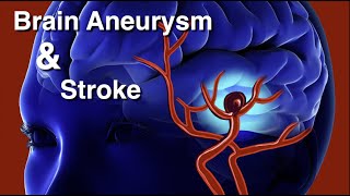 Brain aneurysm and stroke [upl. by Perusse]