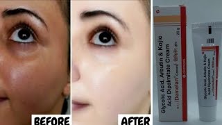 Demelan Creams Review  Pigmentation Removal Cream  How to Use Demelan Cream [upl. by Zel388]