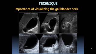 Basic Gallbladder [upl. by Nanreit]