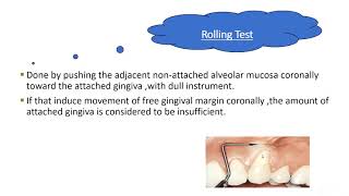 Mucogingival Surgery Dr Enas Elgendy [upl. by Eiznekcm]