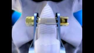 The coflexF® Rivet  Paradigm Spine  Spine Treatment amp Surgery [upl. by Roxine]