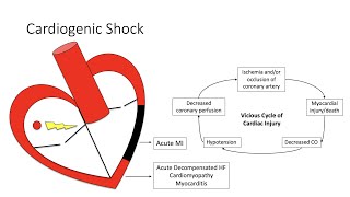 Cardiogenic Shock [upl. by Aerdua481]