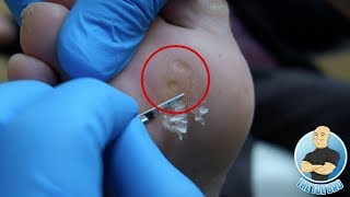 Removal of Painful Foot Callus and Corns for Diabetic Patient 15 Years of Suffering [upl. by Ydnahs]