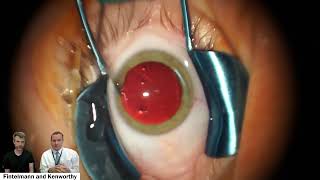 Bilateral Implantable Collamer Lens ICL Insertion [upl. by Neuberger]