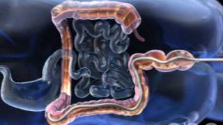 Colonoscopy  3D Medical Animation  ABP © [upl. by Laup]