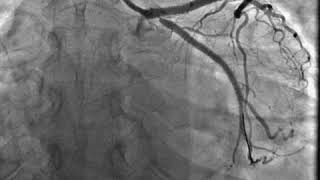 In stent restenosis of OSTIAL LCX [upl. by Arrec970]