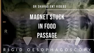 RIGID OESOPHAGOSCOPY  FOREIGN BODY IN OESOPHAGUS  Dr Sharad ENT Videos  youtubevideo surgery [upl. by Repsihw]