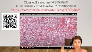 clear cell sarcomaの病理組織像 [upl. by Ynhoj]