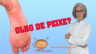 Como eliminar verruga olho de peixe [upl. by Ahseuqram372]