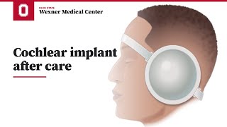 Cochlear implant after care  Ohio State Medical Center [upl. by Dwinnell534]