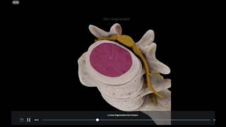 HERNIAS DISCALES Y EL YOGA [upl. by Edelstein120]