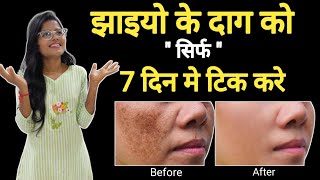 Treatment Of Melasma  7 Dino Me Jhaiyo Ke Dag Mitaye  In Hindi [upl. by Dagmar]