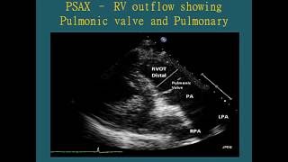 Normal Views  Transthoracic Echocardiogram TTE [upl. by Kilah]