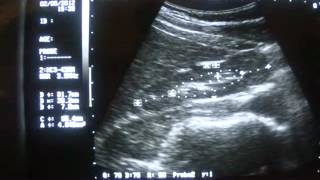 RT SMALL and LT NORMAL KIDNEY [upl. by Ula180]