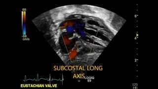 Routine Pediatric Echo  VSD PDA PFO [upl. by Netsyrc]