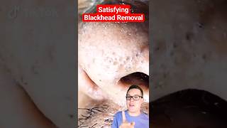 Crazy BLACKHEAD REMOVAL  Blackhead Extraction shorts [upl. by Nnyroc]