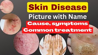 skin disease picture with name  skin problem with namecause symptoms common treatment nsgcare [upl. by Helsa]