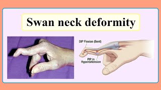 swan neck deformity [upl. by Aetnahs610]