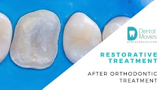 Restorative treatment after orthodontic treatment [upl. by Yerag828]